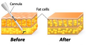 Liposuction Special, Daniel Brown M.D