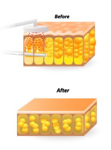 Liposuction Special, Daniel Brown M.D